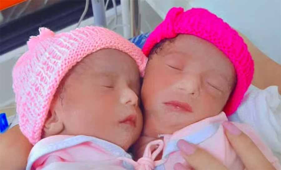 Gêmeas siamesas ligadas por um só coração morrem seis dias após nascimento em hospital de Brasília