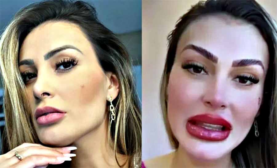 Andressa Urach realiza preenchimento labial e reflete sobre investimento na aparência